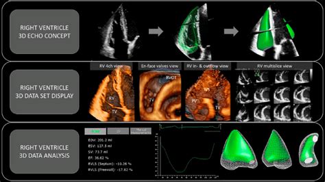 3d rv volume scan